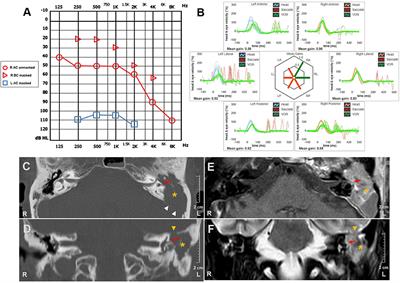 Case Report: Could Hennebert's Sign Be Evoked Despite Global Vestibular Impairment on Video Head Impulse Test? Considerations Upon Pathomechanisms Underlying Pressure-Induced Nystagmus due to Labyrinthine Fistula